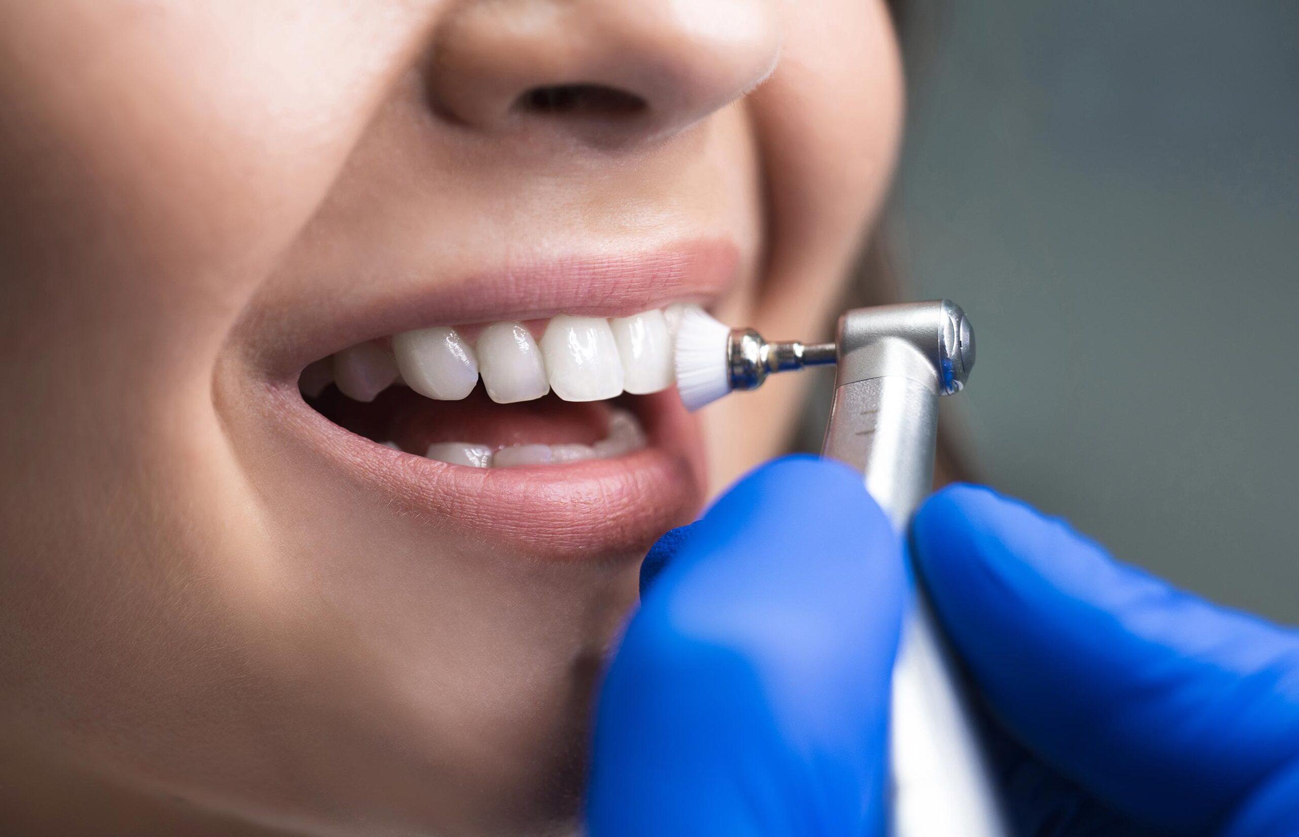 how-often-dental-hygiene-and-teeth-cleanings-victoria-trail-dental-general-family-dentist-edmonton-alberta