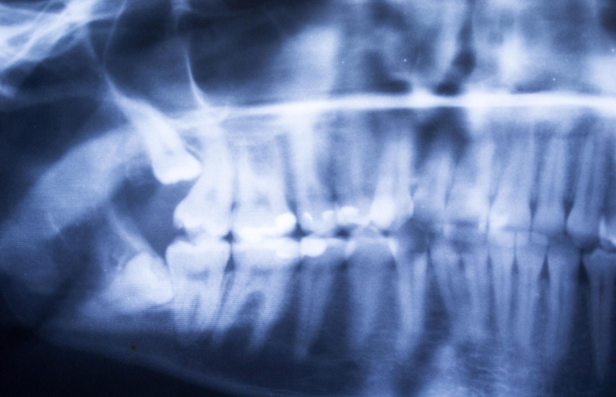 supporting-comfort-during-treatment-wisdom-tooth-removal-victoria-trail-dental-general-family-dentist-edmonton-alberta