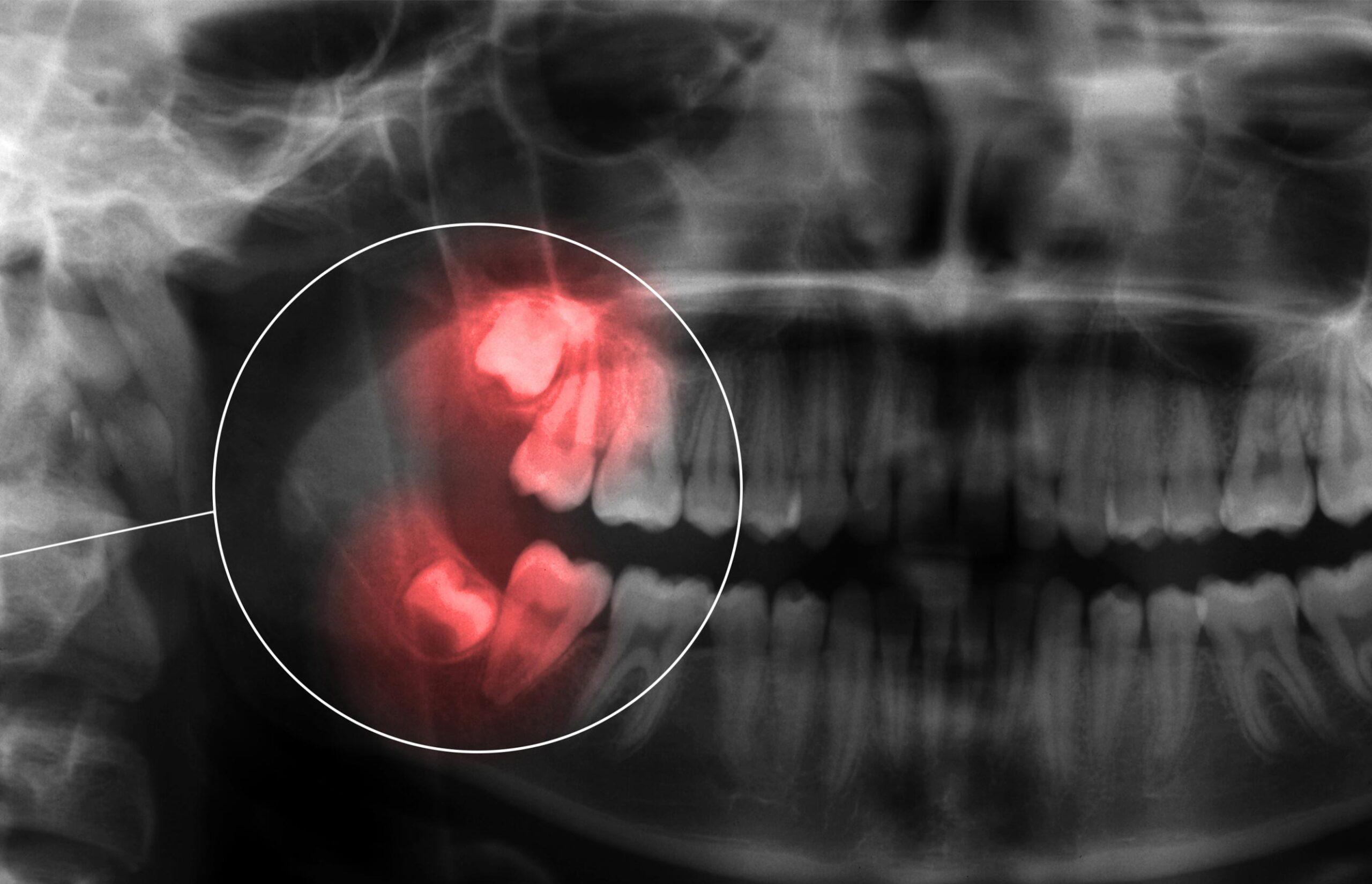 what-to-expect-wisdom-tooth-removal-victoria-trail-dental-general-family-dentist-edmonton-alberta