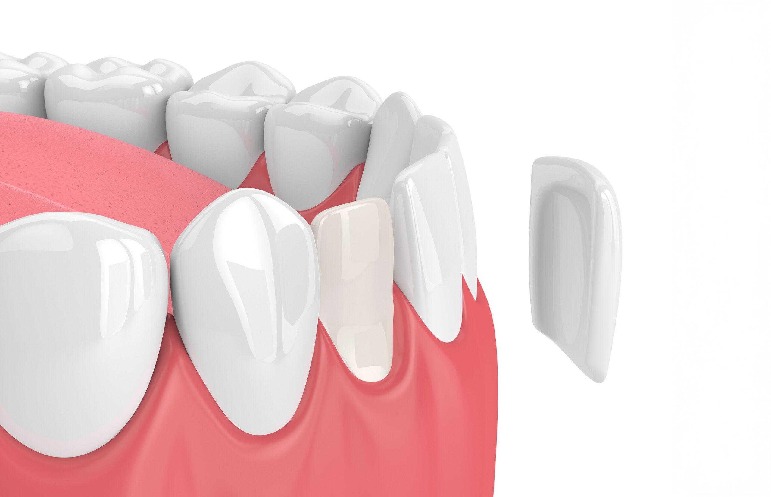 when-dental-veneers-may-be-considered-dental-veneers-victoria-trail-dental-general-family-dentist-edmonton-alberta